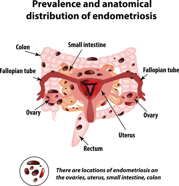 Endometriose ausgelöst durch NICO-Herde- (Neralgia Inducing Chronic Ostitis)?