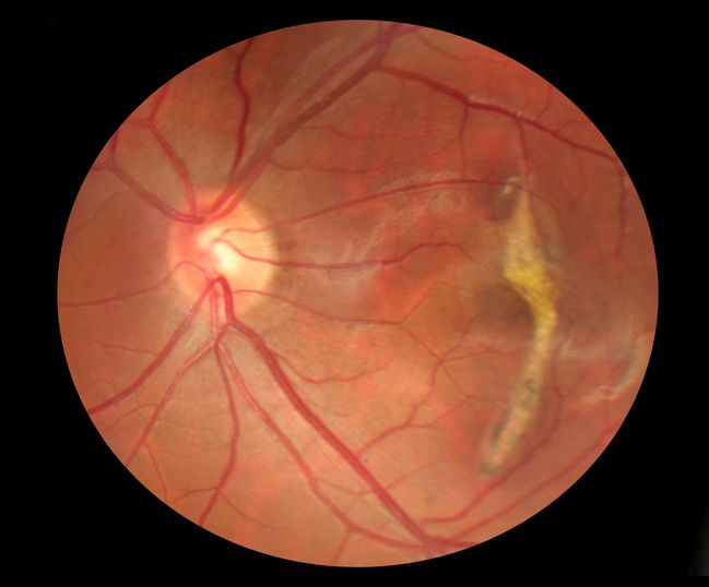 Regenerative Mitochondrien-Medizin bei Makuladegeneration einer chronischen Erkrankung des Auges